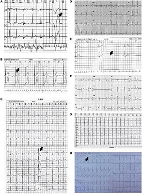 Congenital Anomalous Origin of Coronary Artery Disease in Children With Syncope: A Case Series